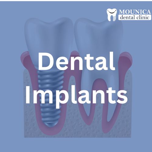 Dental Implants in Guntur