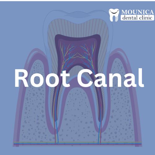 Root Canal Treatment in Guntur